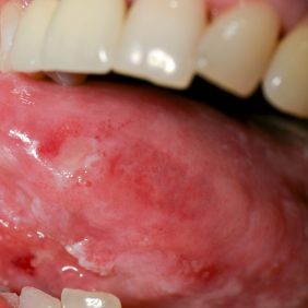 papillomavírus na jazyku